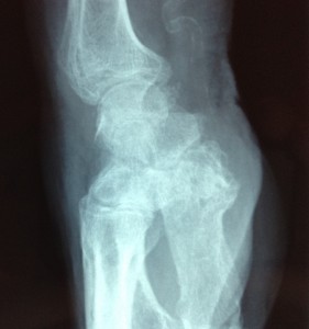 rhizarthrose radiographie profil sos main trappes paris vercoutere