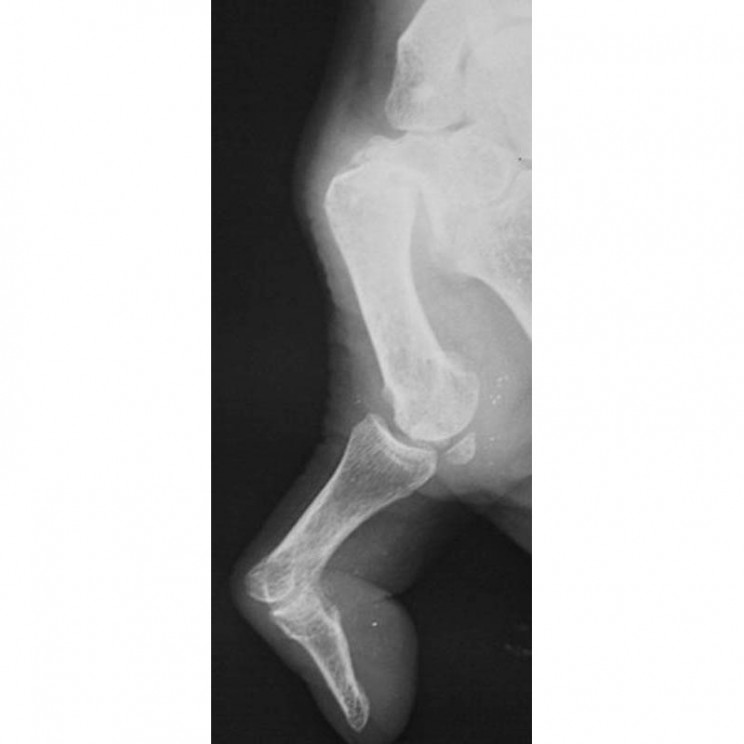 arthrose base du pouce rhizarthrose sos main trappes paris vercoutere