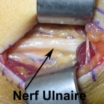 vue operatoire du nerf cubital au coude lors d'une neurolyse