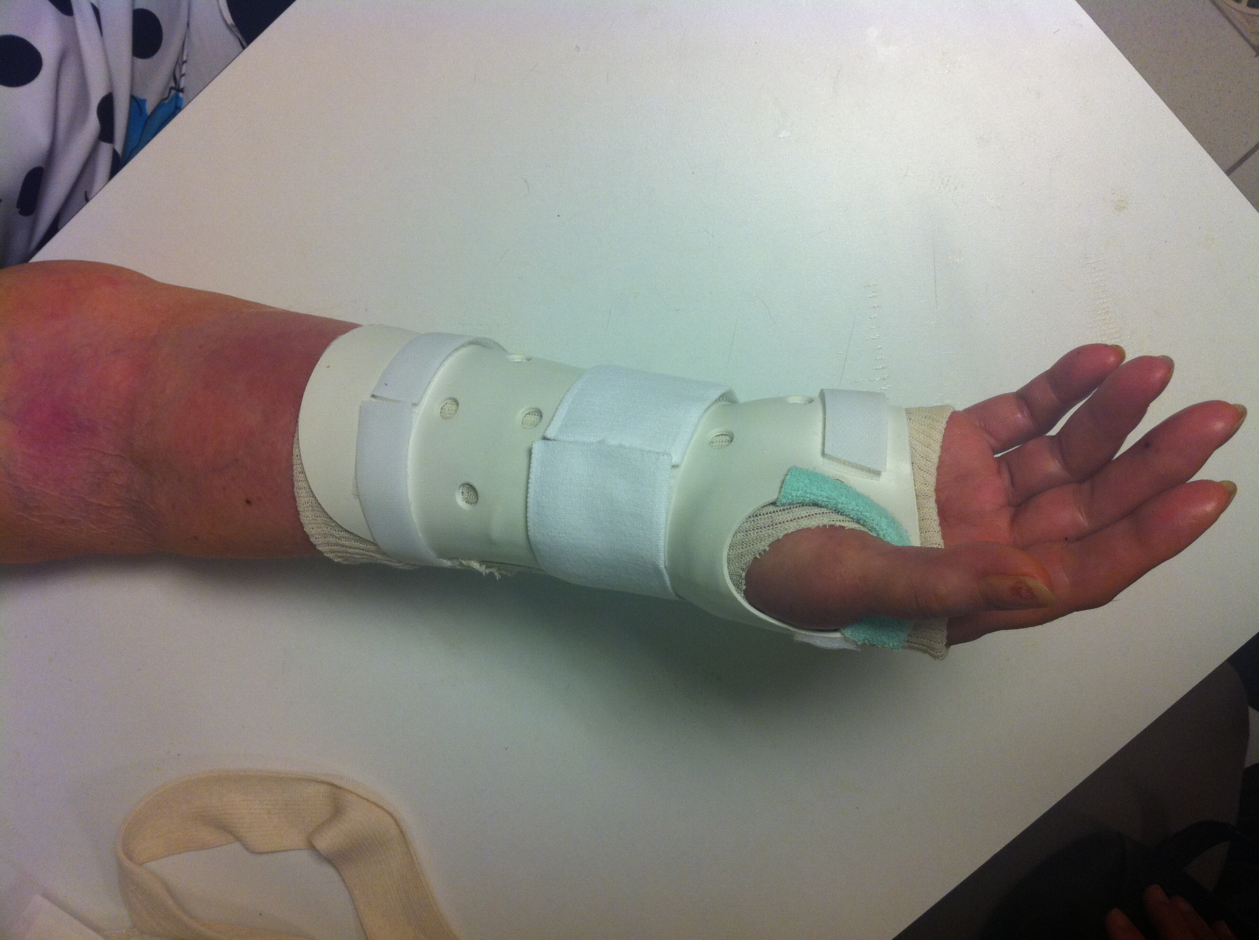 Fracture du poignet | L'institut de chirurgie de la main de l ...