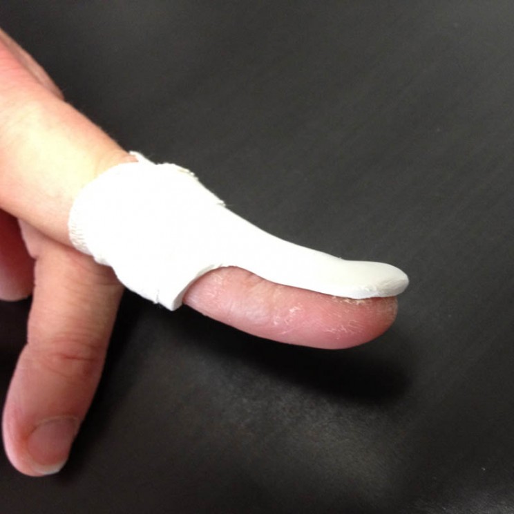 mallet finger doigt en maillet sos main trappes paris vercoutere