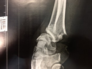 cture du radius distal poignet