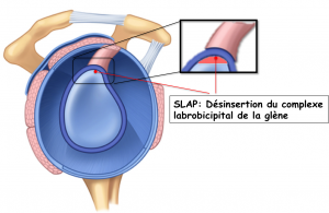 lésion du complexe labrobicipital ou SLAP lésion