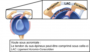 voute sous acromiale et ligament acromio coracoïdien
