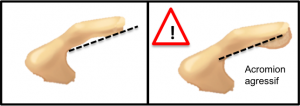 conflit sous acromial acromion coiffe des rotateurs
