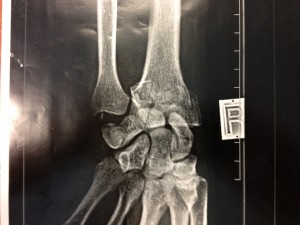 radiographie de face d'une fracture articulaire du poignet déplacée