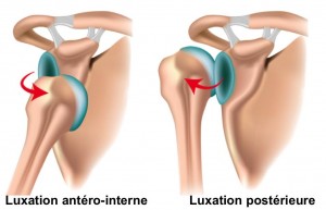 luxation-epaule-antero-interne-posterieure