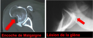 luxation-epaule-encoche-malgaigne-lesion-glene