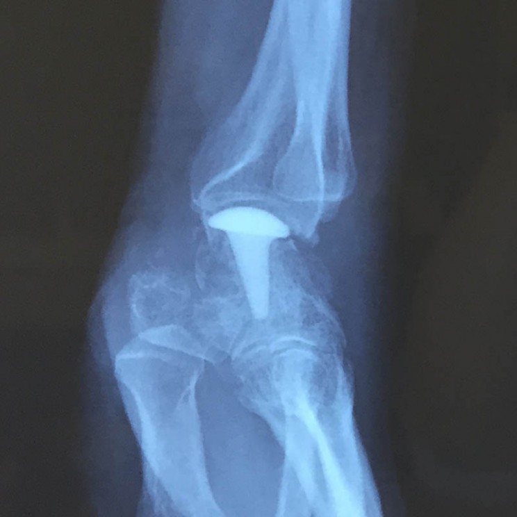 arthrose du poignet implant sos main trappes vercoutere