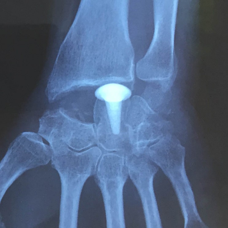 resection de la premiere rangee des os du carpe et implant en pyrocarbone RCPI sos main trappes vercoutere