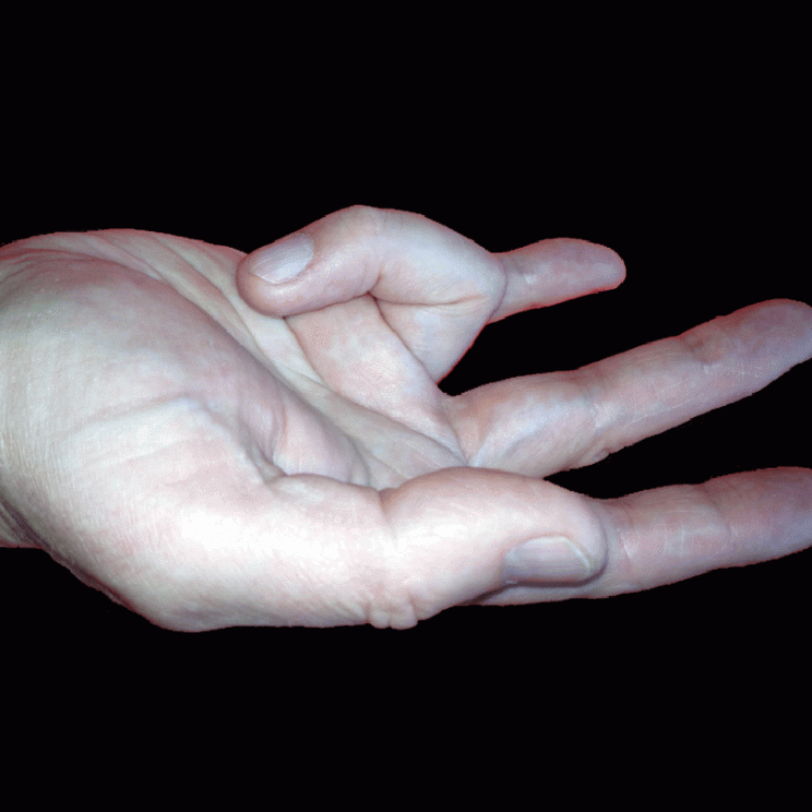 trigger finger