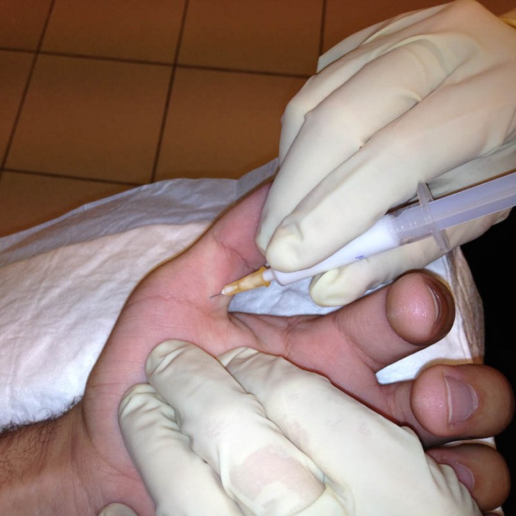 infiltration de corticoides pouce a ressaut sos main trappes vercoutere