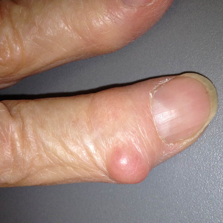 kyste mucoide doigt sos main trappes vercoutere arthrose digitale