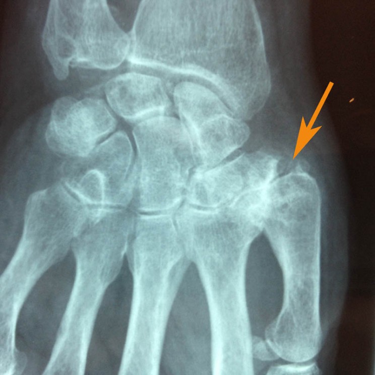arthrose base du pouce rhizarthrose sos main trappes paris vercoutere