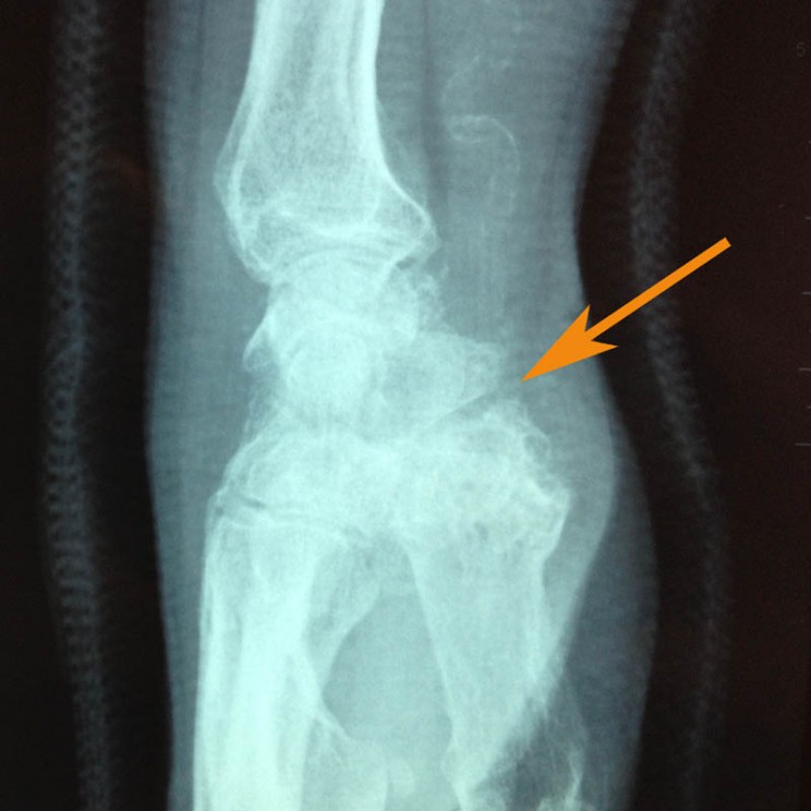 arthrose base du pouce rhizarthrose sos main trappes paris vercoutere