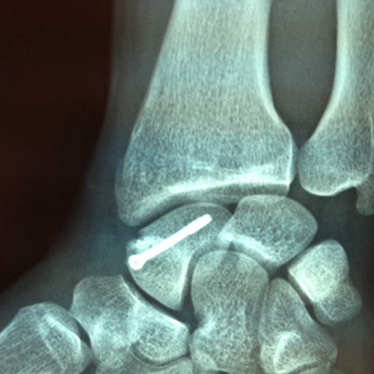 vis compression fracture scaphoide trappes sos main michel vercoutere