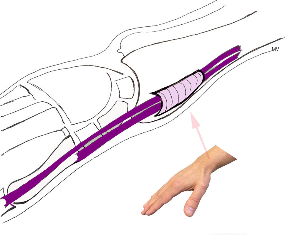 Les tendons du court extenseur et du long abducteur du pouce (en mauve), sont comprimés dans un tunnel au contact du radius (en rose)