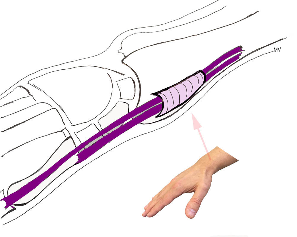 La tendinite de De Quervain. | L'institut de chirurgie de la main ...