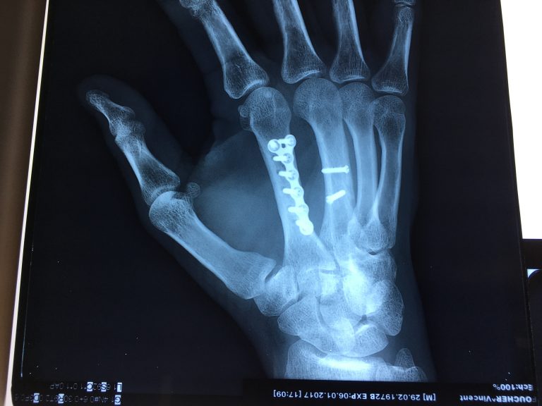 Fracturemétacarpiens L