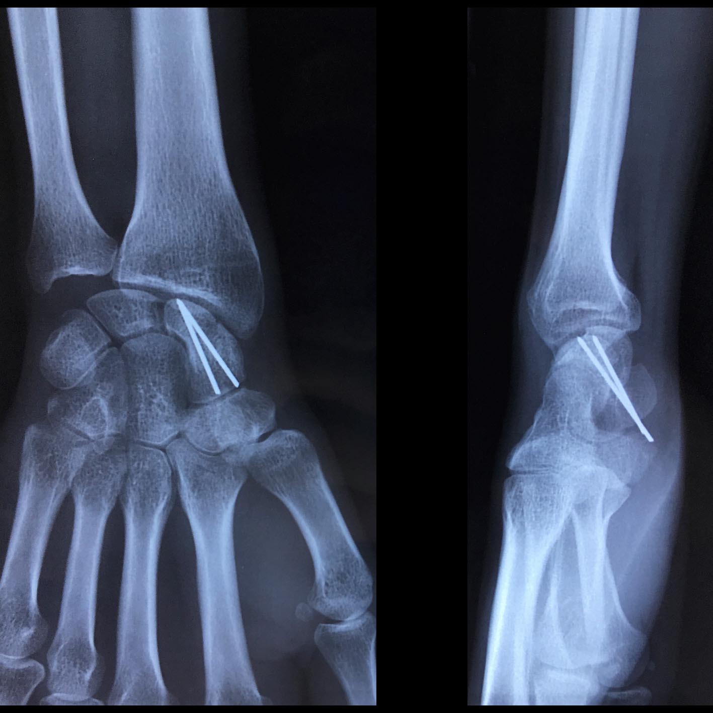 Fracture du scaphoïde et ses complications | L'institut de ...