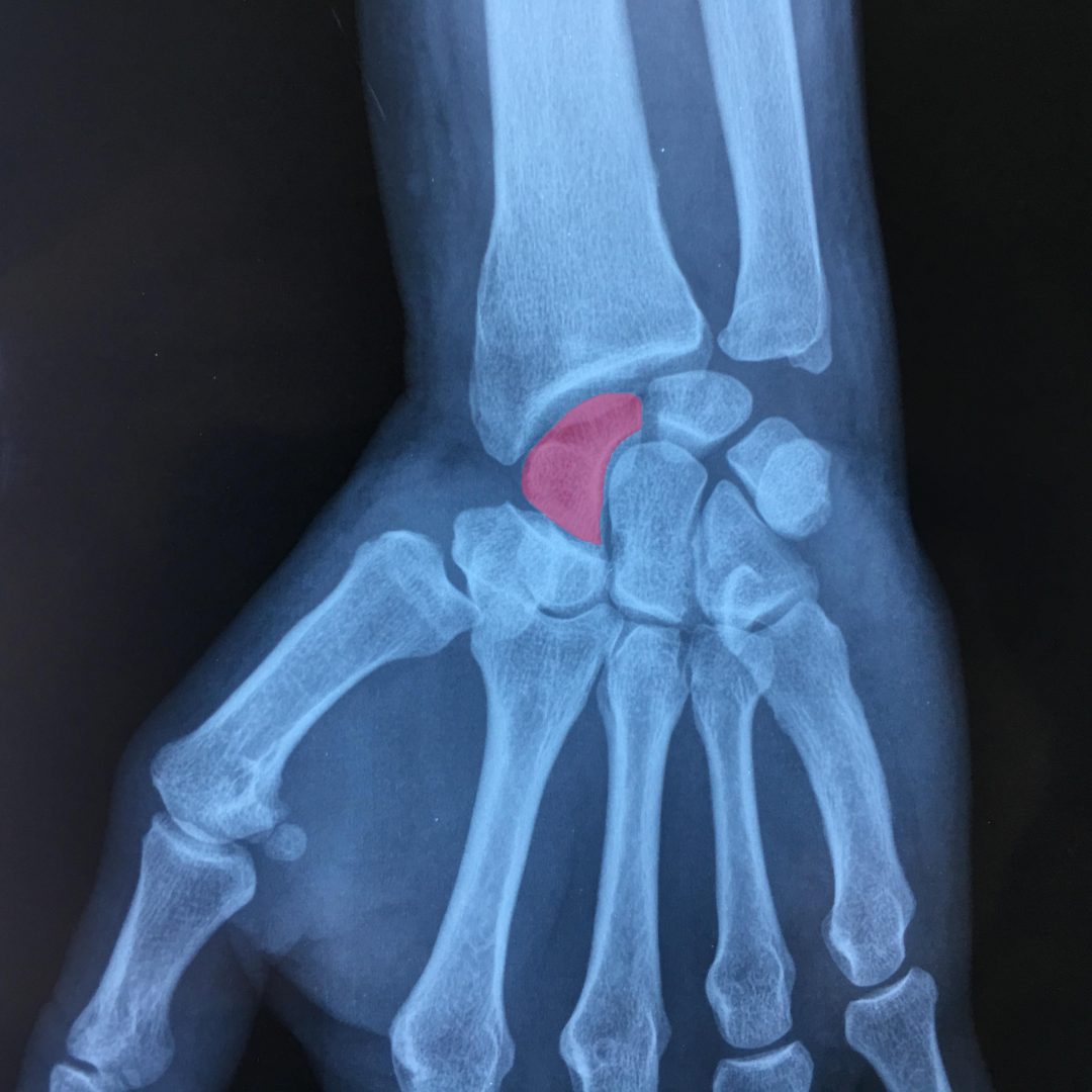 Fracture du scaphoïde et ses complications L