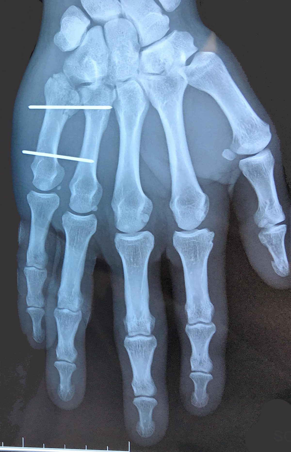 fracturebase5ememetacarpienbroches L