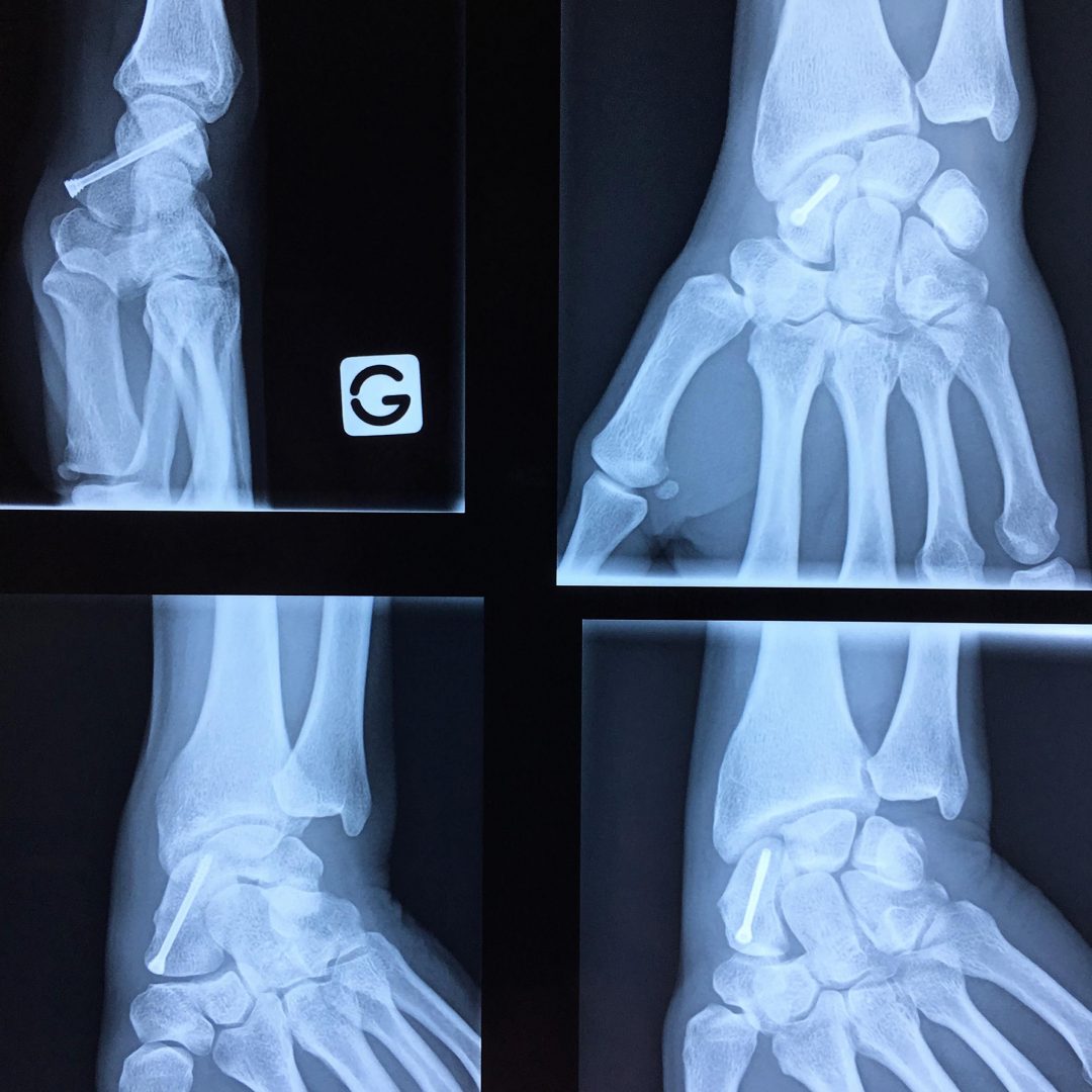 Fracture du scaphoïde et ses complications L