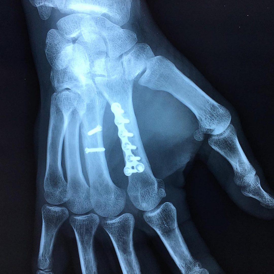 Fractures des 2ème et 3ème métacarpiens | L'institut de chirurgie de la ...