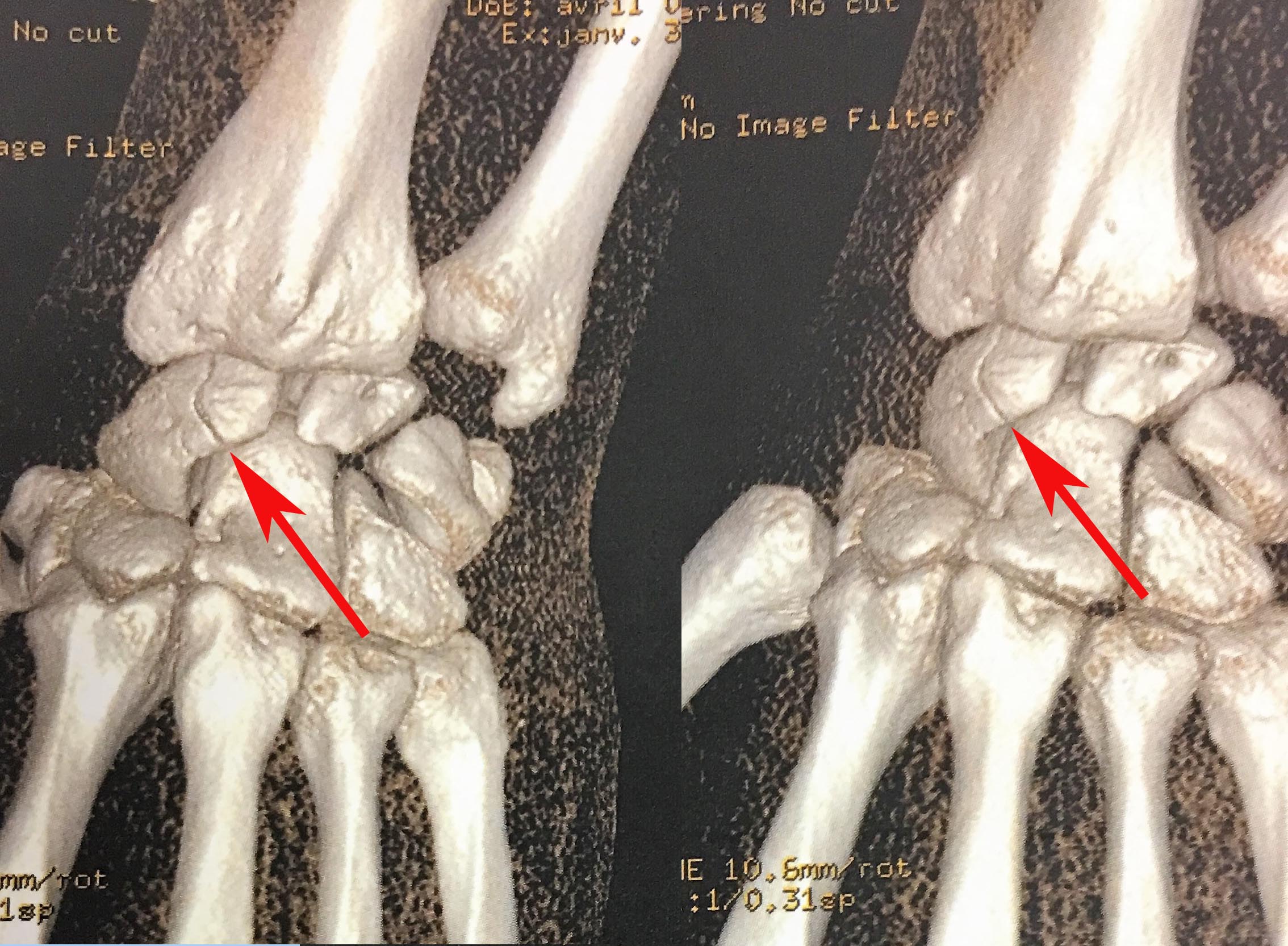 Fracture du scaphoïde et ses complications | L'institut de ...