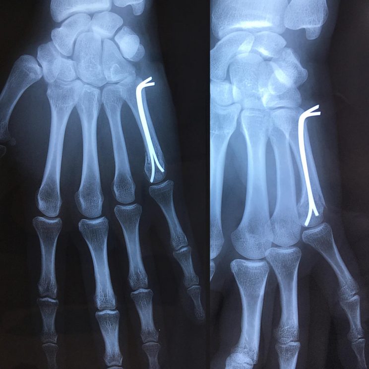 Fracture de la tête du 5ème métacarpien | L'institut de chirurgie de la ...