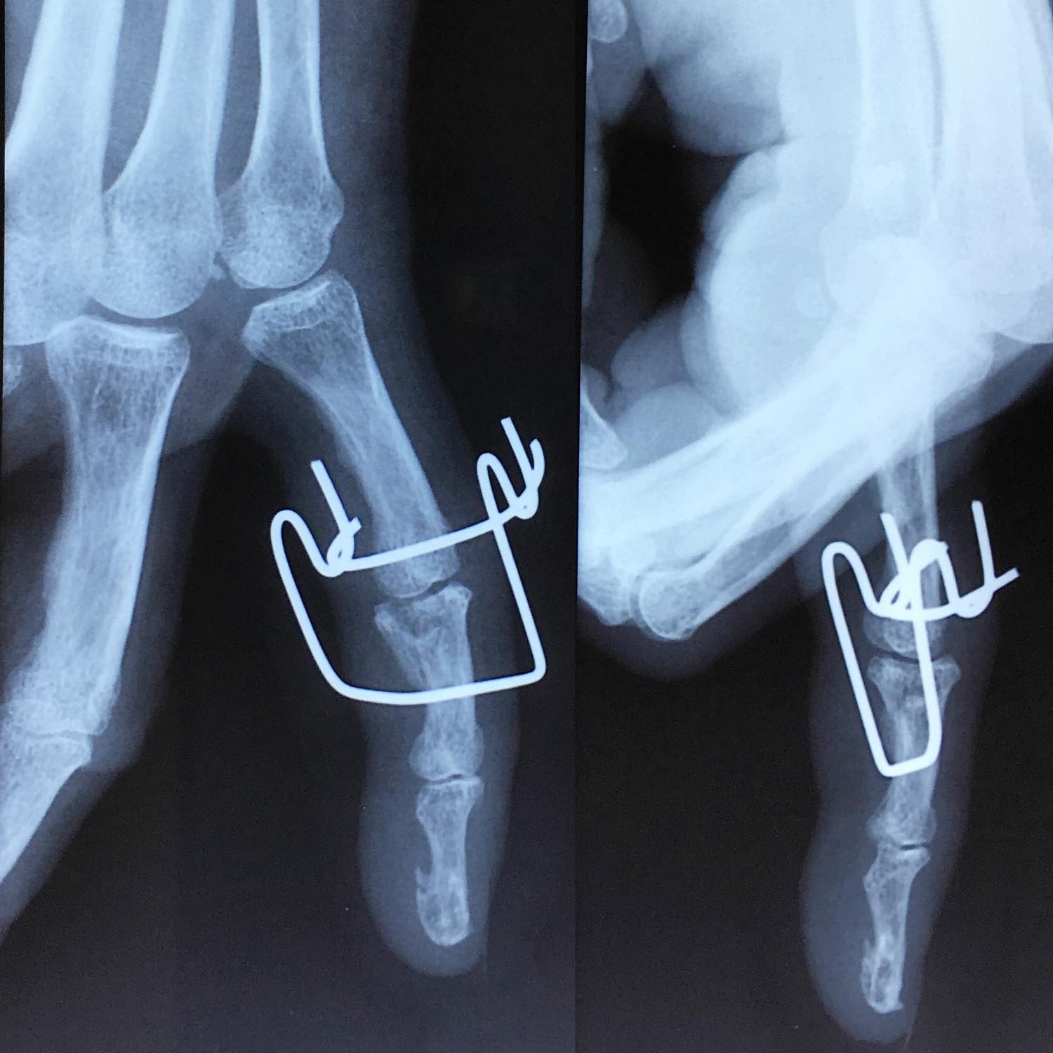 Fractures de la main | L'institut de chirurgie de la main de l ...