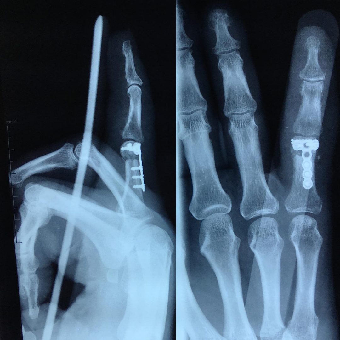 Fracture articulaire et comminutive de la tête de la 1ère phalange du 5ème doigt L