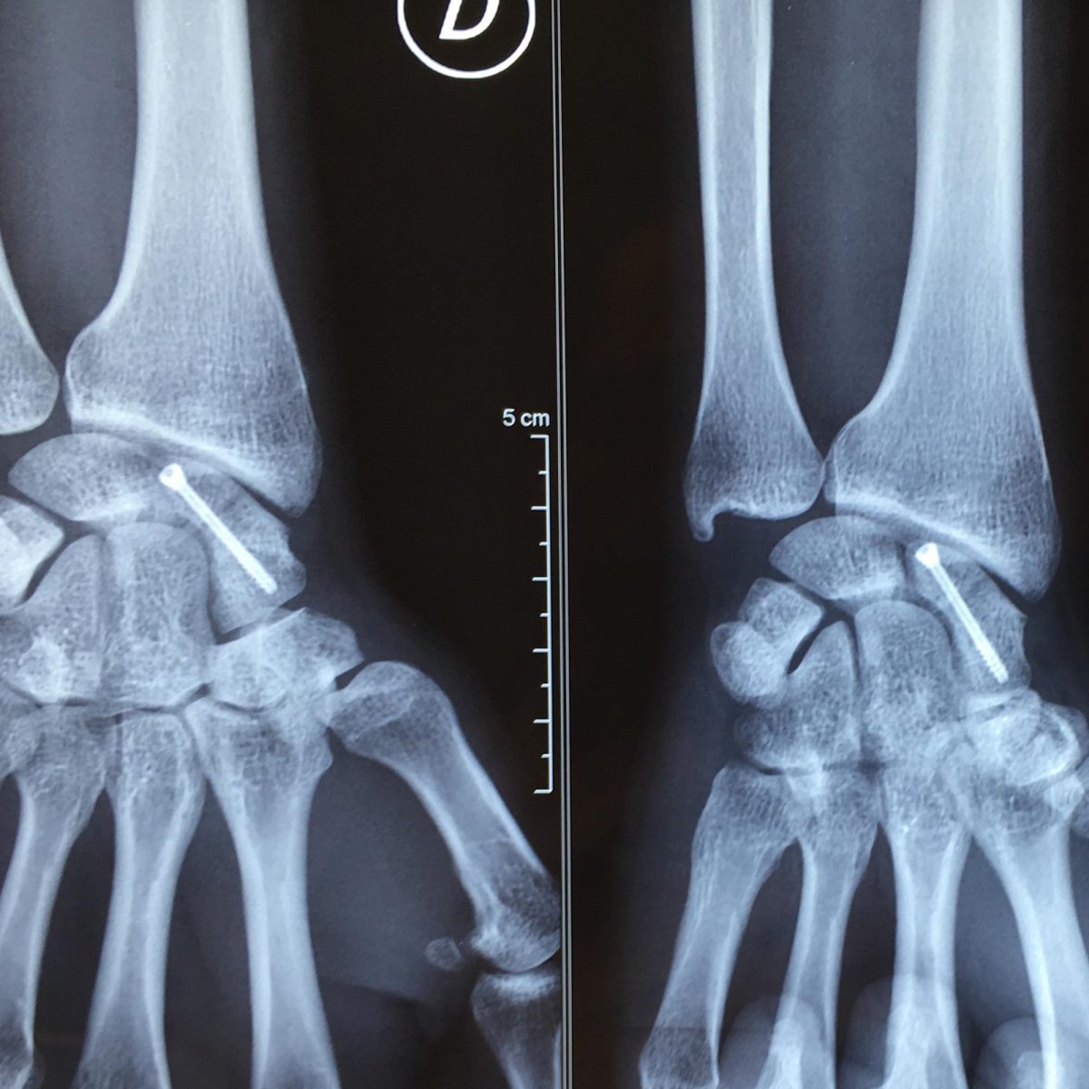 Fracture du scaphoïde et ses complications L